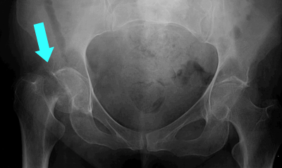 xray of hip fracture