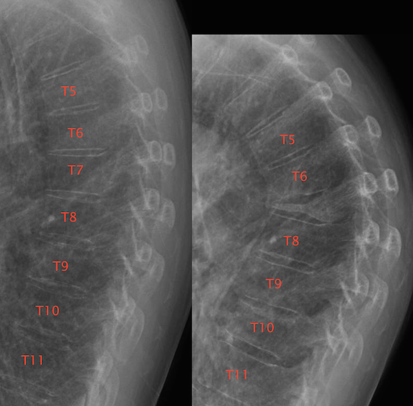 xray of severe fracture