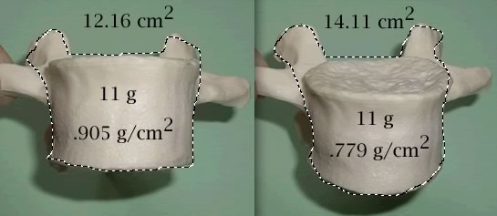 image of rotated vertebra