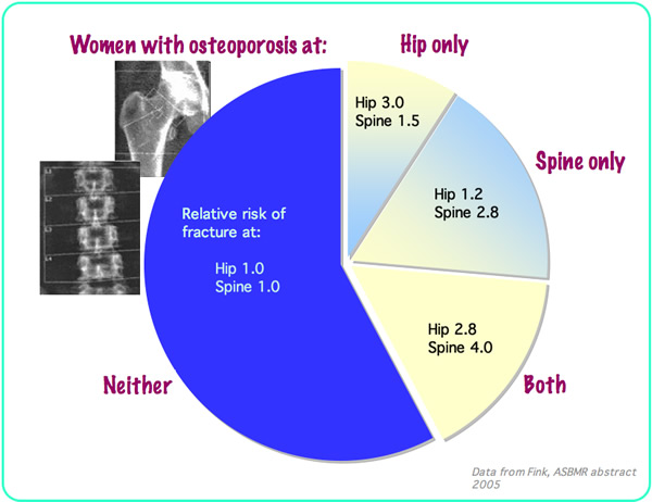 pie chart of fracture prediction by site