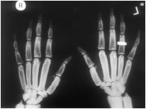 xray of hands