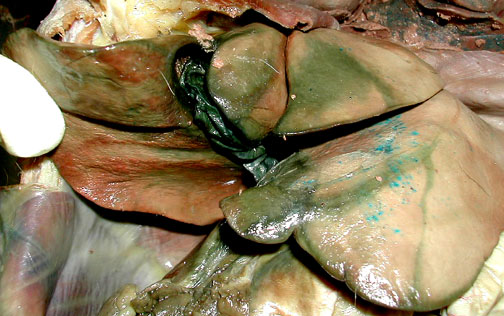 gallbladder removal pictures. dark green gall bladder,