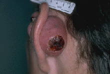 ear nodule