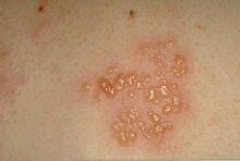 Cutaneous condition - Wikipedia