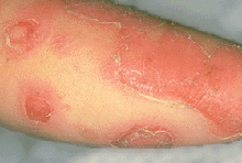 erosion skin lesion