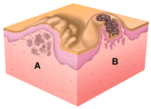 Nodule/tumor