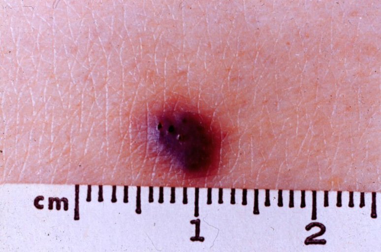 picture of cherry angioma