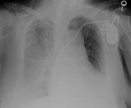 chest x-ray