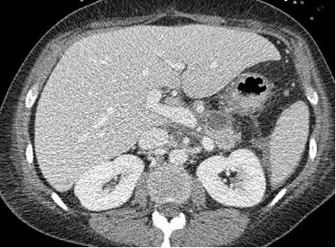 chest CT scan 