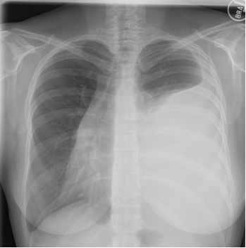 chest x-ray