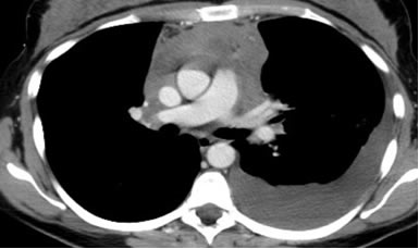 chest CT scan