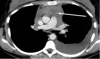 chest CT scan