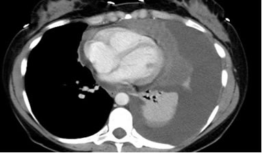 chest CT scan