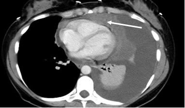 chest CT scan