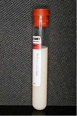 thoracentesis fluid sample in test tube