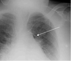 x-ray showing intravascular catheter in thoracic cavity