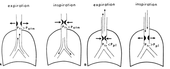 Intra and extrathoracic large airway obstructing lesions