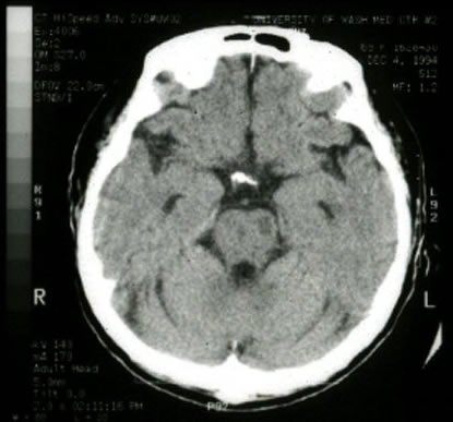CT - an acute lacunar infarct is identified in the left basis pontis.