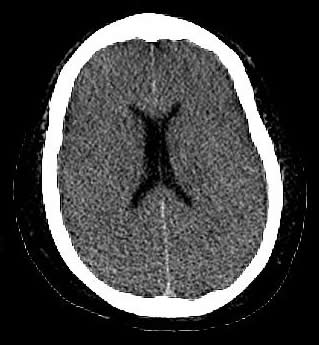 CT - axial cut rhough the lateral ventricles showing homogeneous brain parenchyma without gray-white junction anywhere.