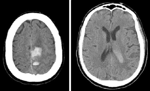 Two cuts are shown - an acute subcortical hemorrhage is seen adjacent to the falx with surrounding edema.
