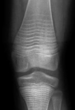 xray of osteogensis imperfecta treated with pamidronate