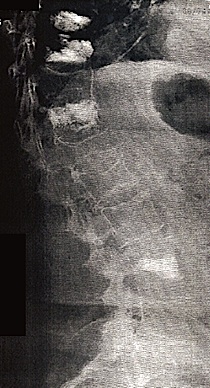 xrays showing several vertebroplasties