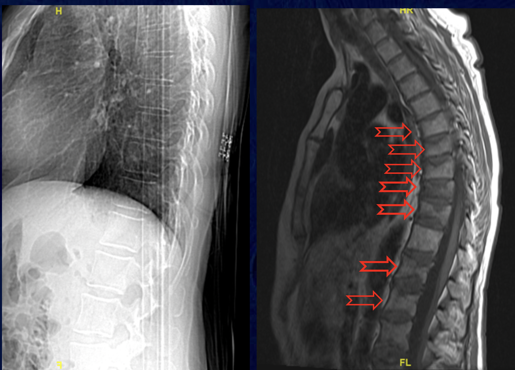 xrays of multiple vertebral fractures