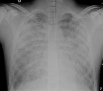 Ards Chest X Ray