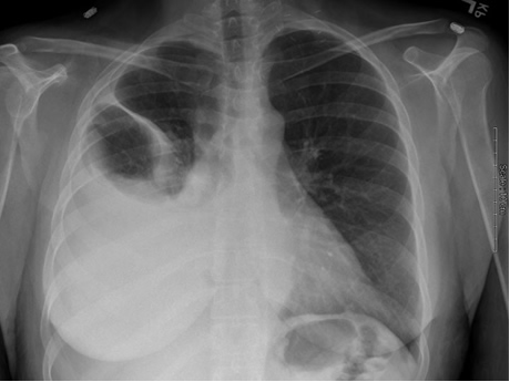 chest x-ray