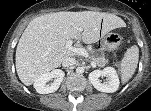 chest CT scan 