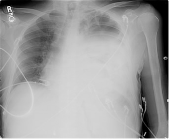 pleural effusion chest x ray