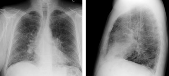 PA and laterial chest x ray
