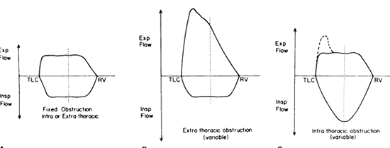 kyphoscoliosis flow volume loop